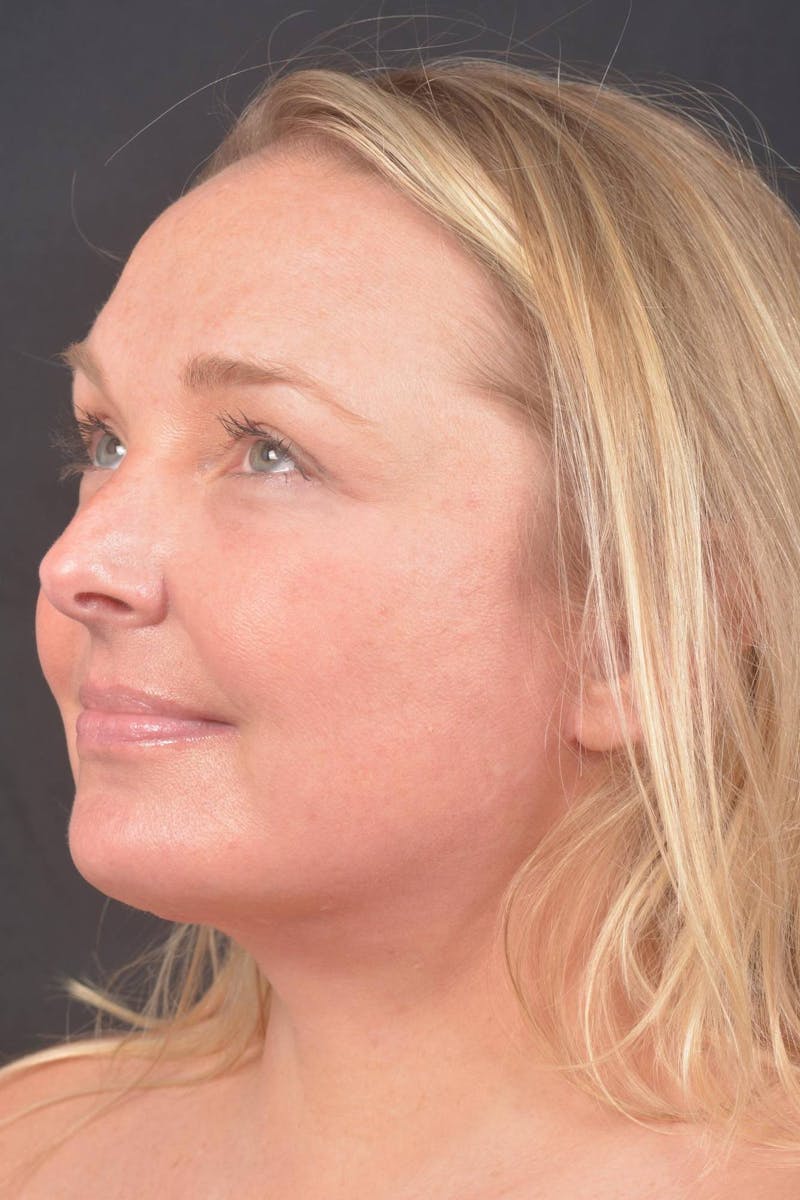 Facelift Before & After Gallery - Patient 125952 - Image 8