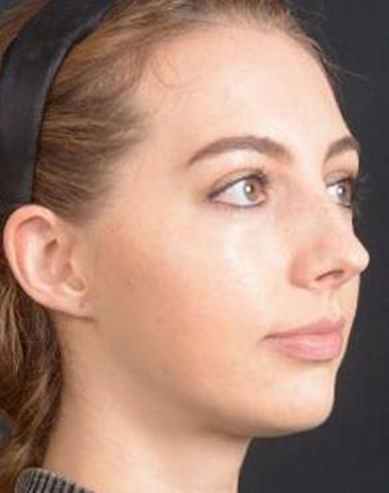 Rhinoplasty Before & After Gallery - Patient 385171 - Image 9
