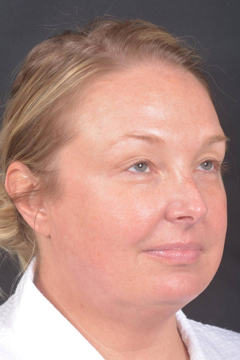 Facelift Before & After Gallery - Patient 125952 - Image 9