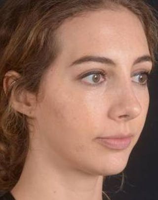 Rhinoplasty Before & After Gallery - Patient 385171 - Image 10