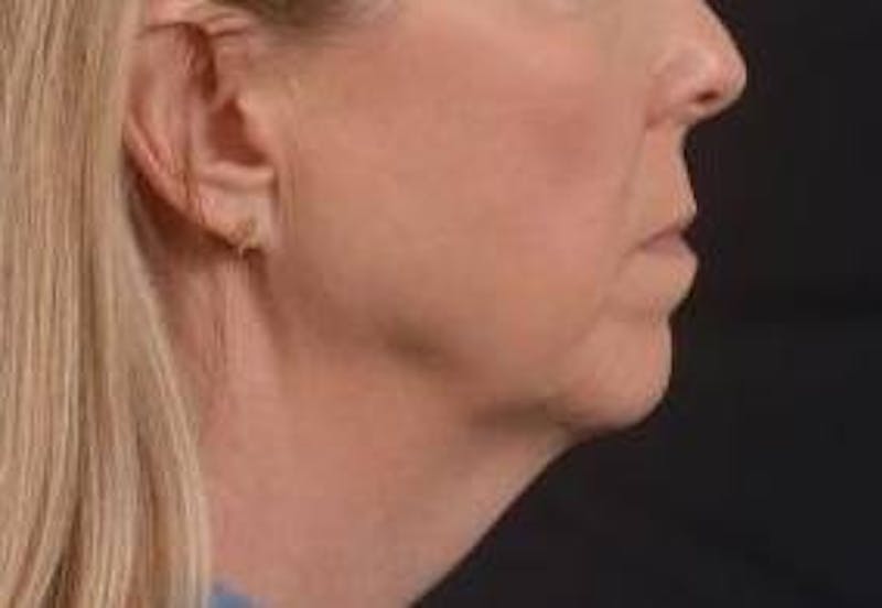 Necklift Before & After Gallery - Patient 115178 - Image 5