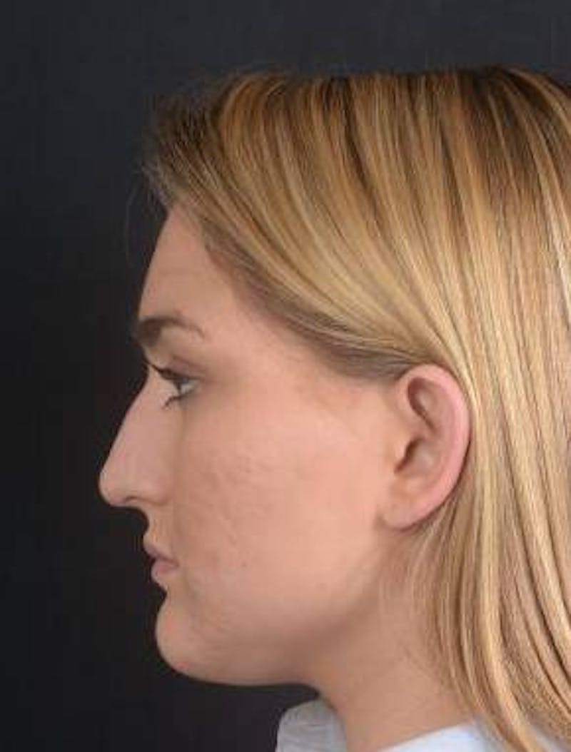 Rhinoplasty Before & After Gallery - Patient 187205 - Image 3
