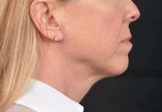 Necklift Before & After Gallery - Patient 115178 - Image 6