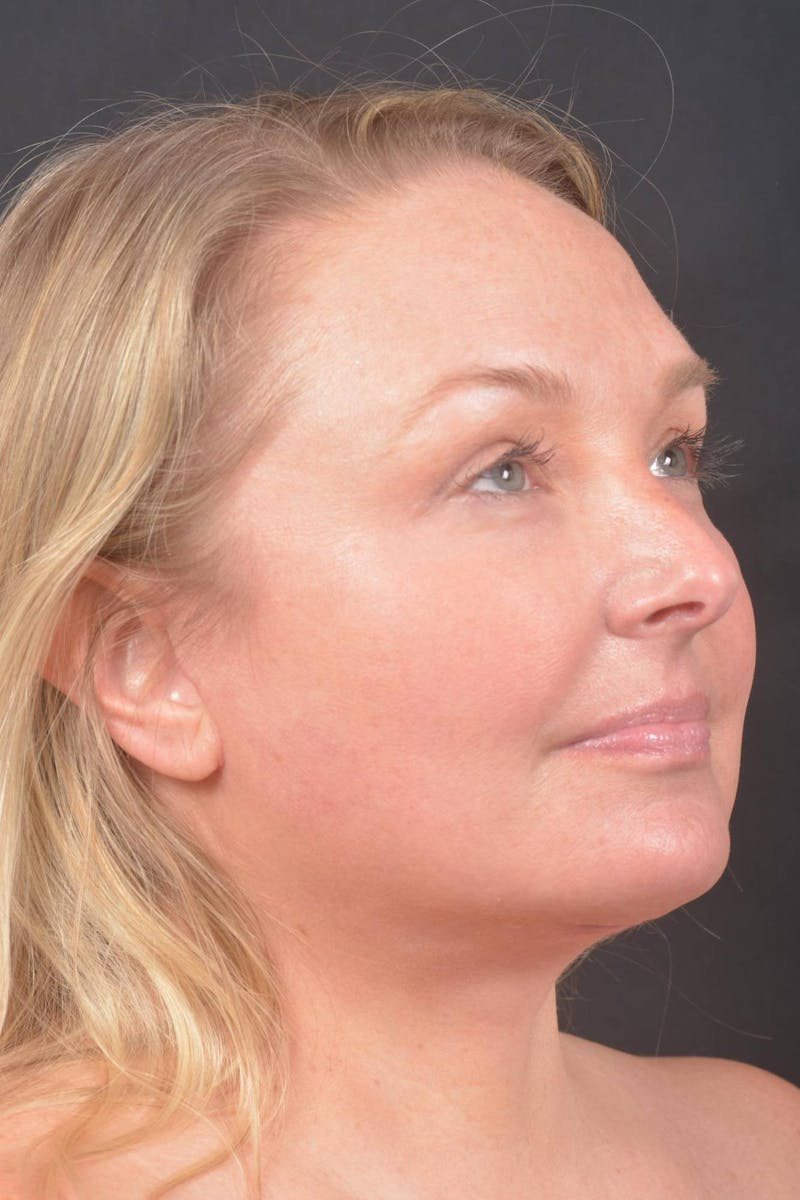 Facelift Before & After Gallery - Patient 125952 - Image 10