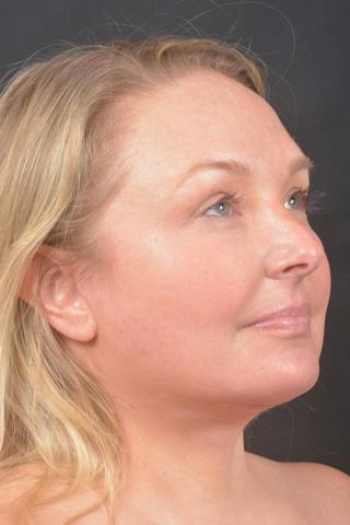 Facelift Before & After Gallery - Patient 125952 - Image 10