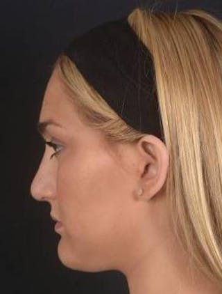 Rhinoplasty Before & After Gallery - Patient 187205 - Image 4