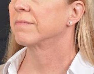 Necklift Before & After Gallery - Patient 115178 - Image 8