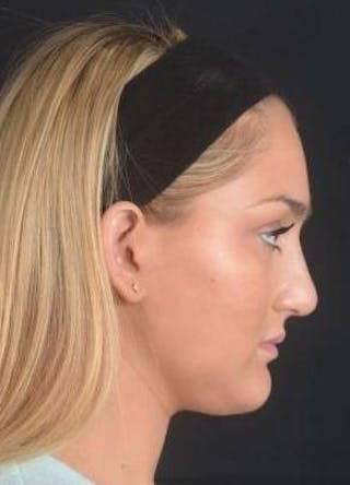 Rhinoplasty Before & After Gallery - Patient 187205 - Image 6