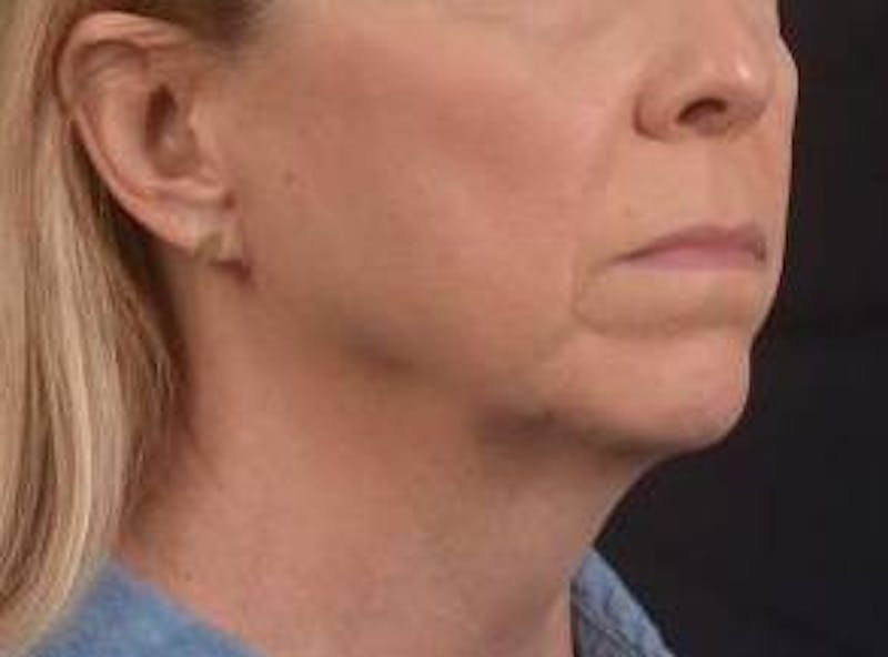 Necklift Before & After Gallery - Patient 115178 - Image 9