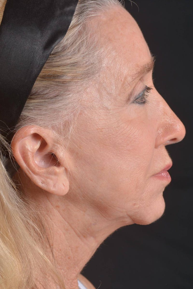 Facelift Before & After Gallery - Patient 262486 - Image 5