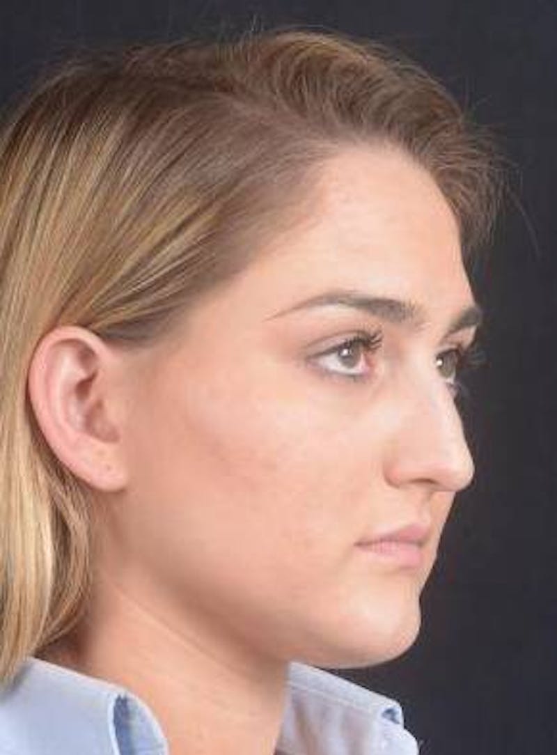 Rhinoplasty Before & After Gallery - Patient 187205 - Image 9