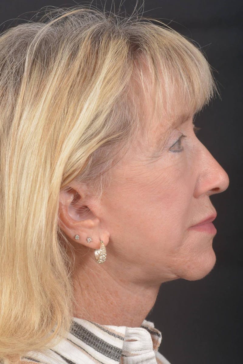 Facelift Before & After Gallery - Patient 262486 - Image 6