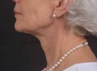Necklift Before & After Gallery - Patient 420798 - Image 4
