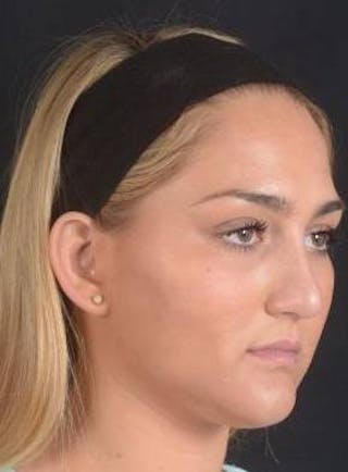 Rhinoplasty Before & After Gallery - Patient 187205 - Image 10