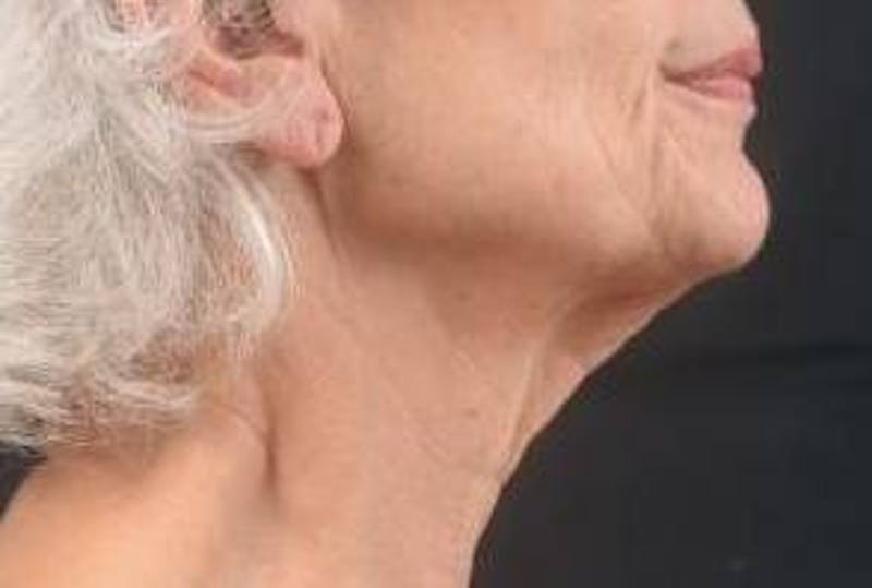 Necklift Before & After Gallery - Patient 420798 - Image 5