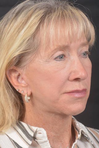 Facelift Before & After Gallery - Patient 262486 - Image 10