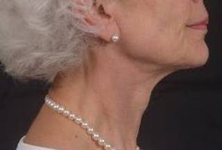Necklift Before & After Gallery - Patient 420798 - Image 6