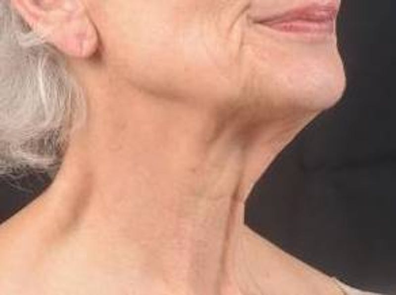 Necklift Before & After Gallery - Patient 420798 - Image 9