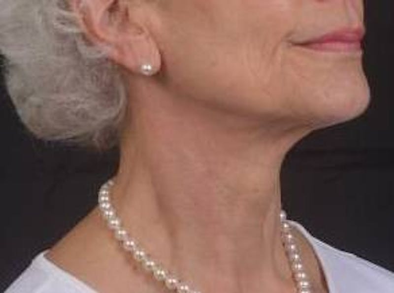 Necklift Before & After Gallery - Patient 420798 - Image 10