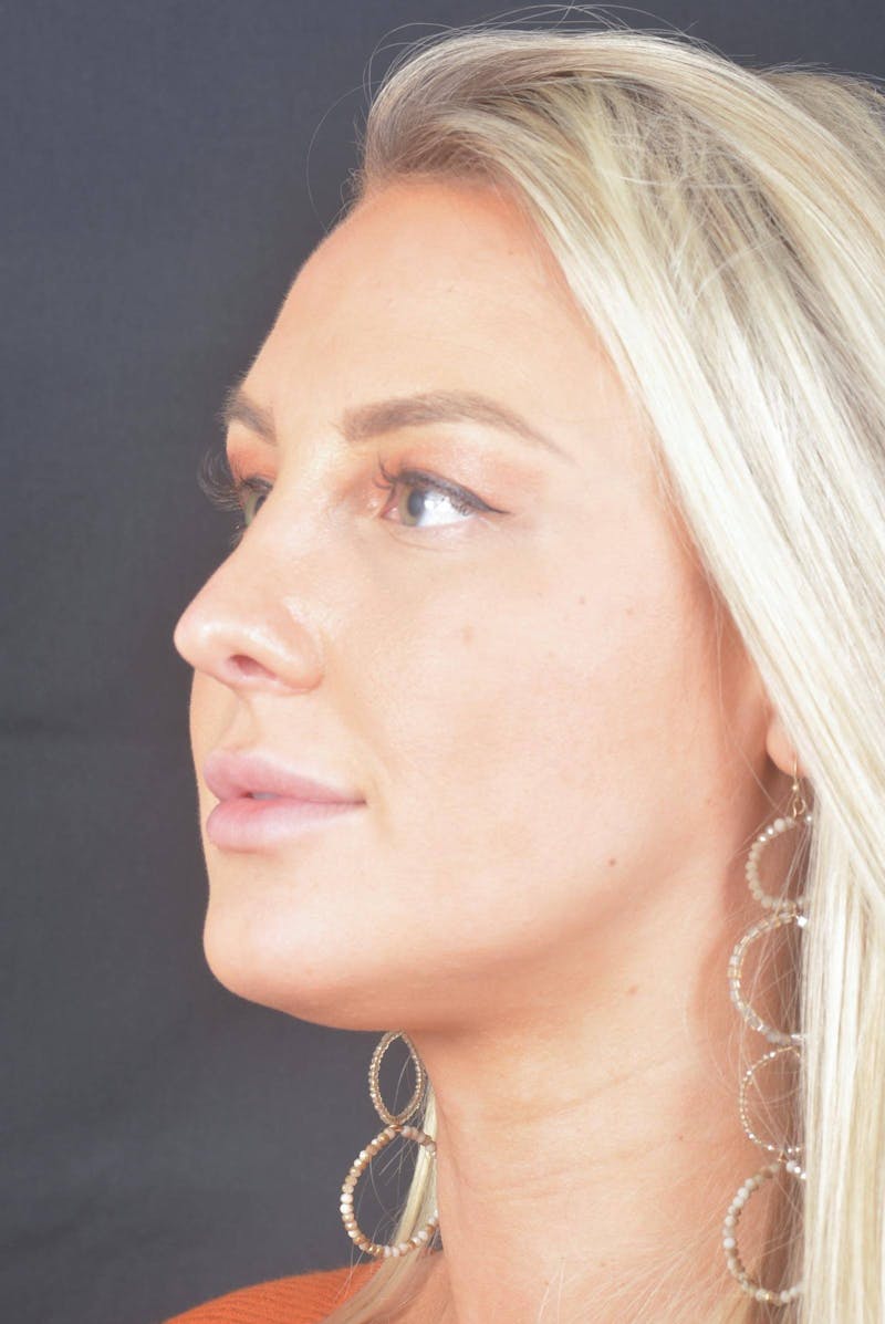 Rhinoplasty Before & After Gallery - Patient 150086 - Image 8