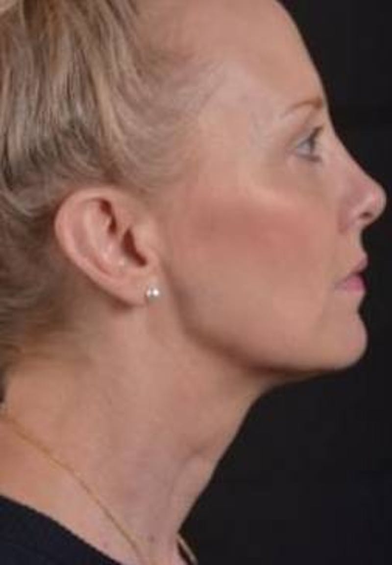 Necklift Before & After Gallery - Patient 303828 - Image 5