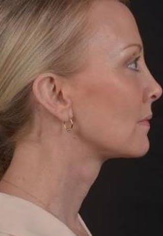 Necklift Before & After Gallery - Patient 303828 - Image 6