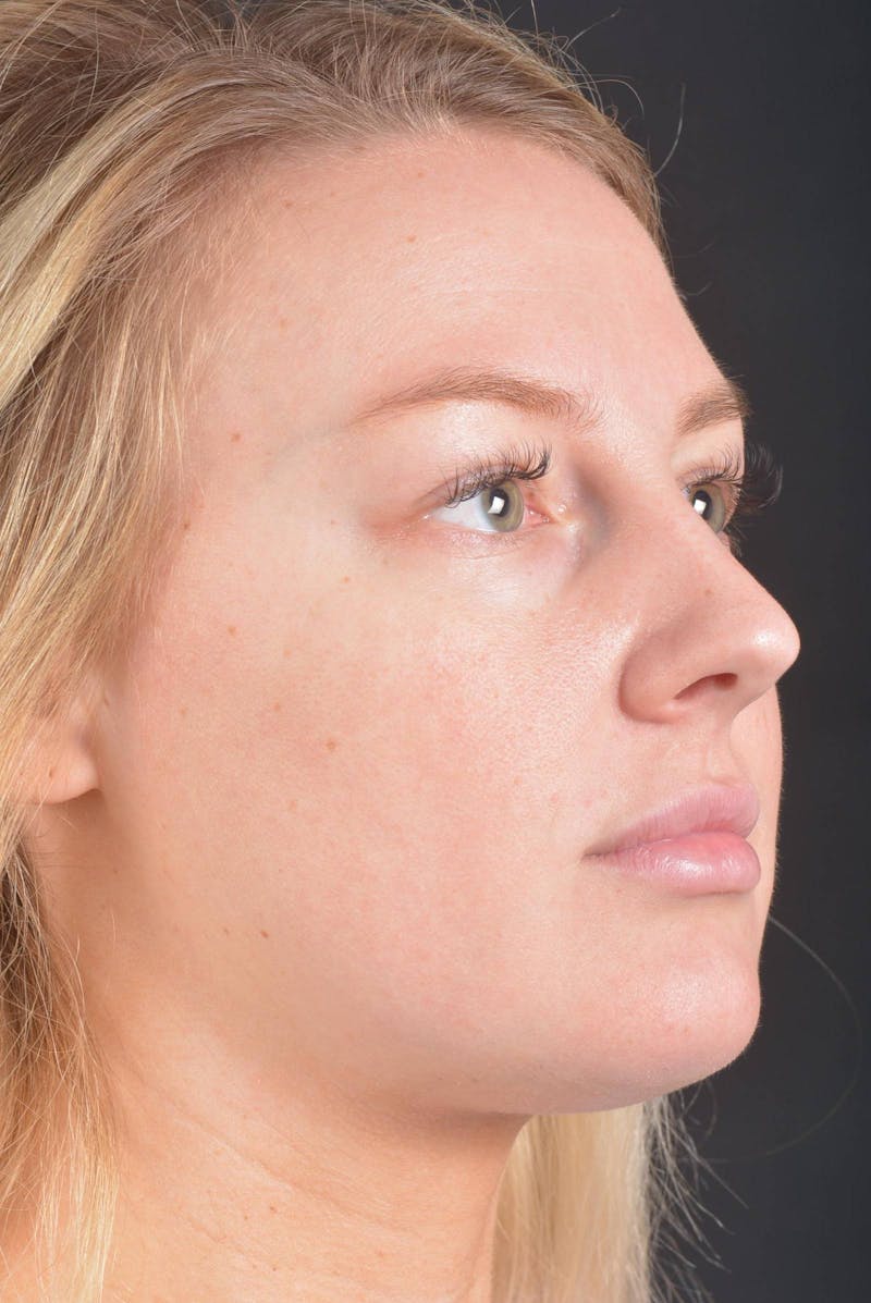 Rhinoplasty Before & After Gallery - Patient 150086 - Image 9