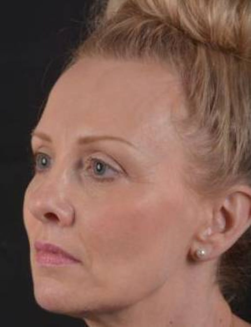 Necklift Before & After Gallery - Patient 303828 - Image 7