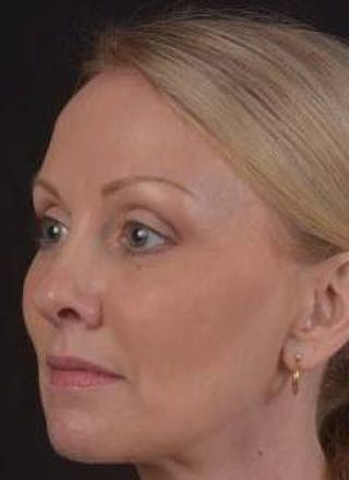 Necklift Before & After Gallery - Patient 303828 - Image 8