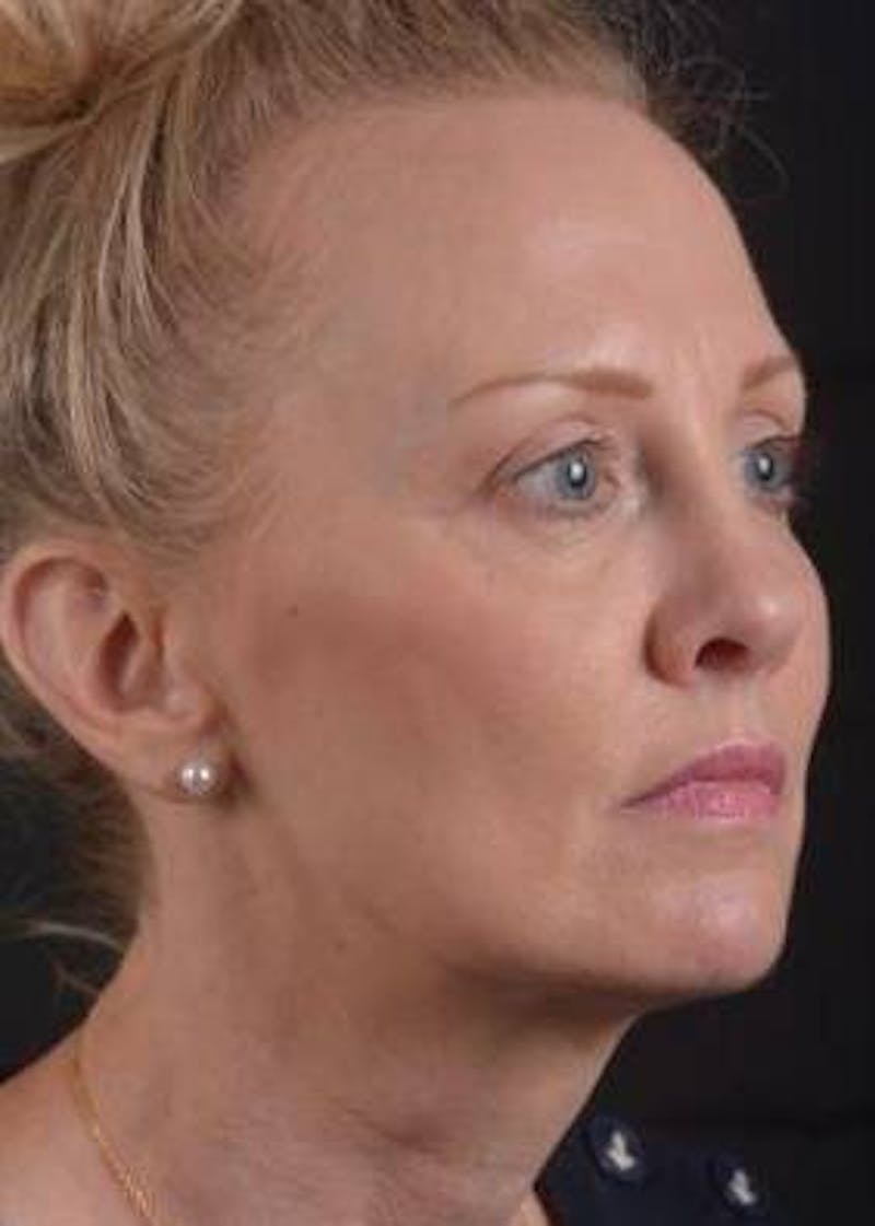 Necklift Before & After Gallery - Patient 303828 - Image 9