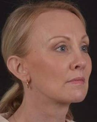 Necklift Before & After Gallery - Patient 303828 - Image 10