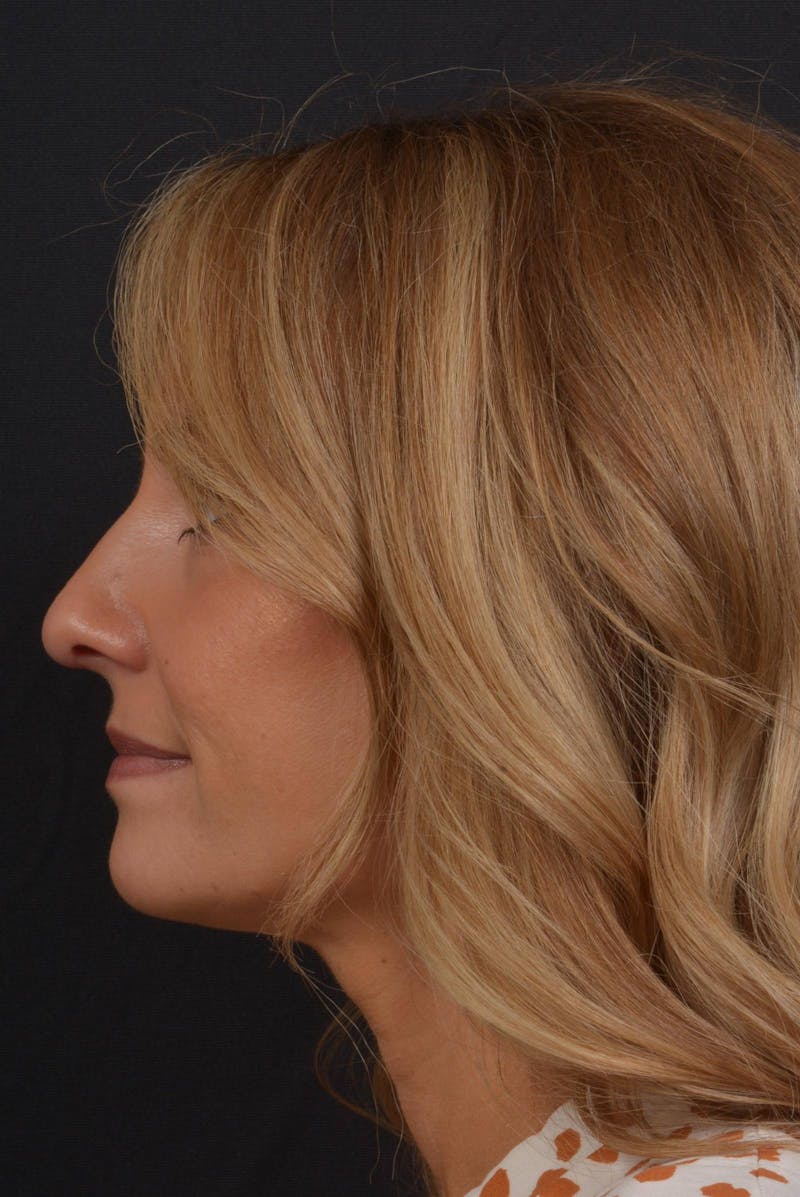 Rhinoplasty Before & After Gallery - Patient 325130 - Image 4