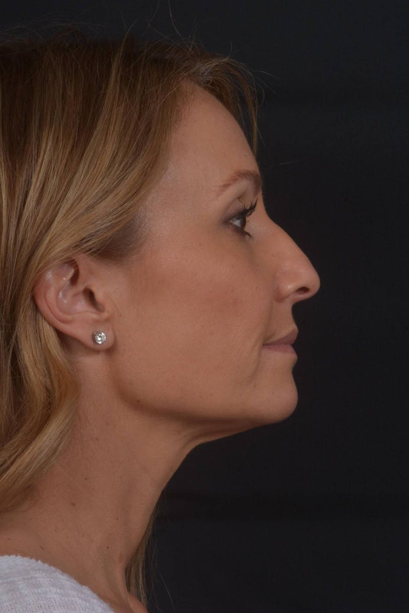 Rhinoplasty Before & After Gallery - Patient 325130 - Image 5