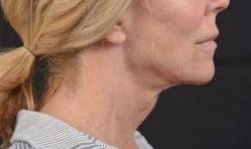 Necklift Before & After Gallery - Patient 164755 - Image 5