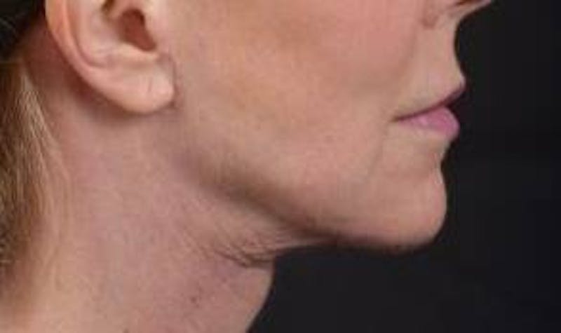 Necklift Before & After Gallery - Patient 164755 - Image 6