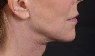 Necklift Before & After Gallery - Patient 164755 - Image 6