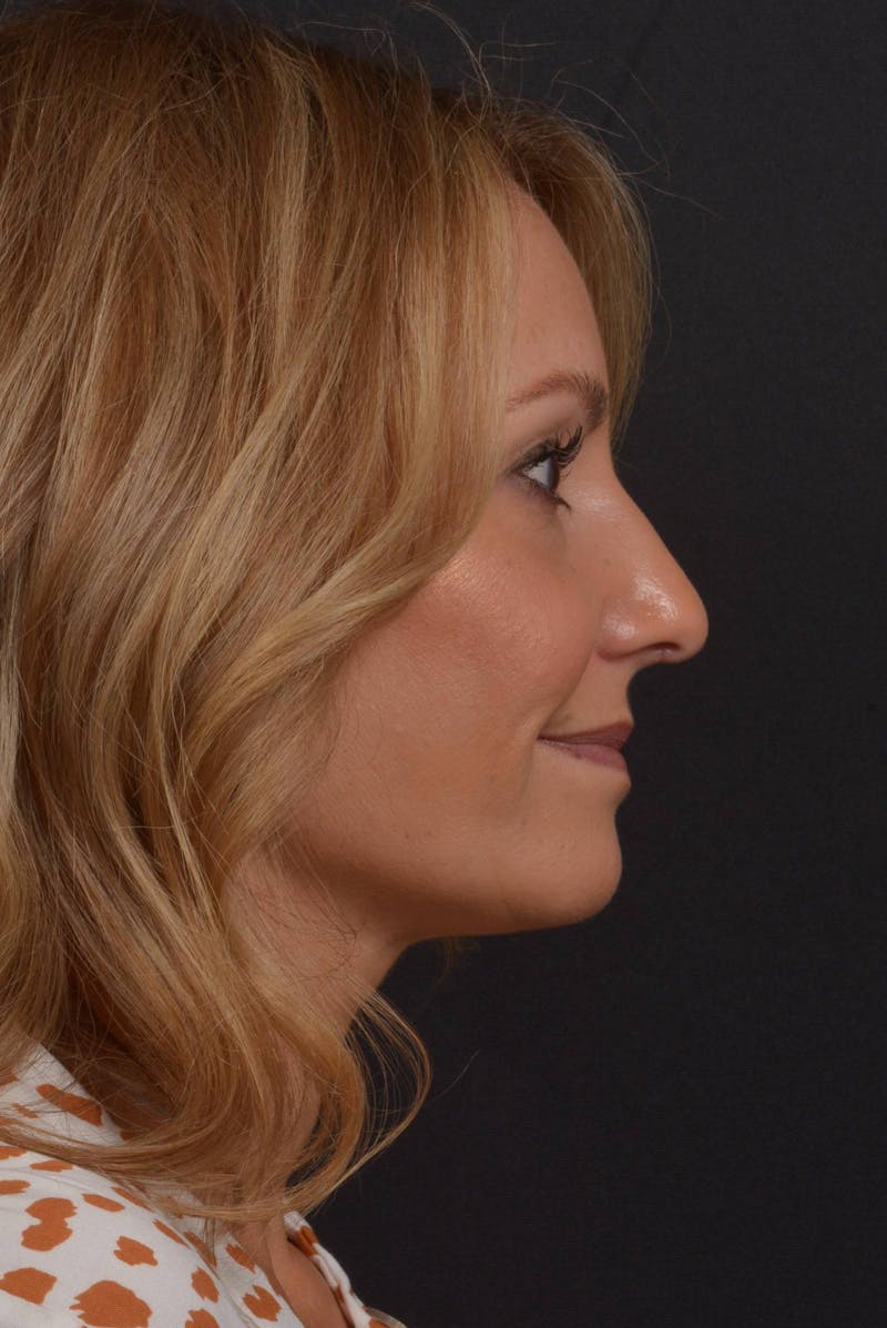 Rhinoplasty Before & After Gallery - Patient 325130 - Image 6