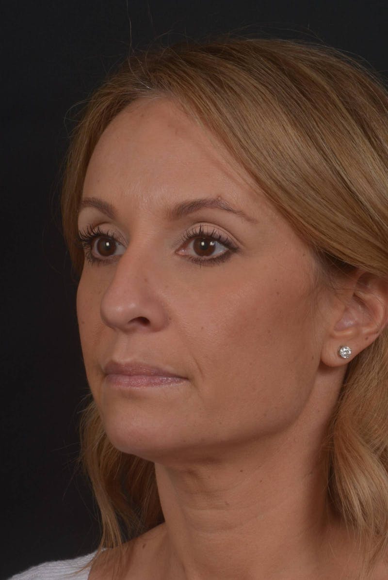 Rhinoplasty Before & After Gallery - Patient 325130 - Image 7