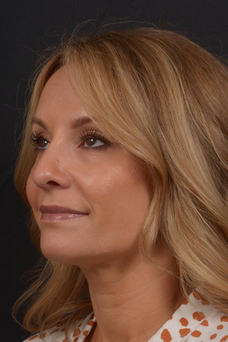 Rhinoplasty Before & After Gallery - Patient 325130 - Image 8
