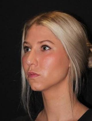 Rhinoplasty Before & After Gallery - Patient 395551 - Image 4