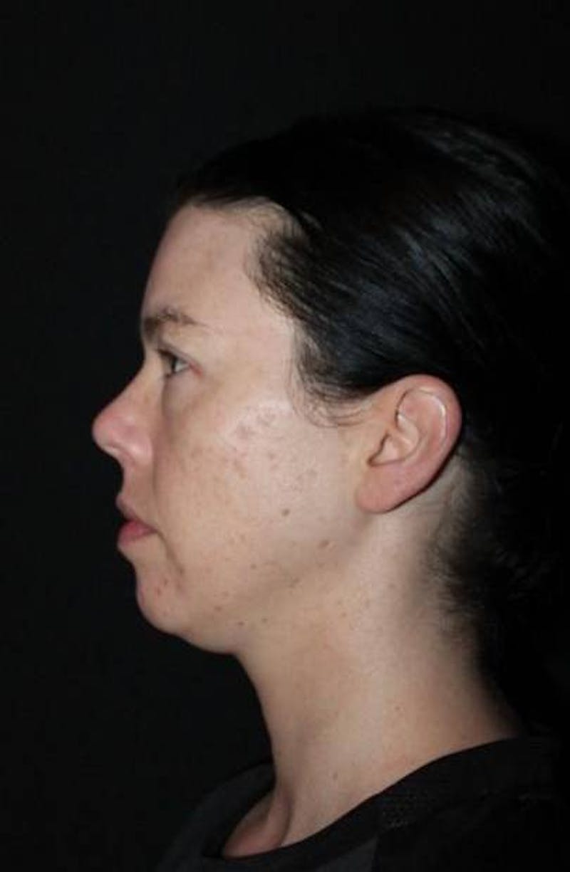 Browlift Before & After Gallery - Patient 396351 - Image 5