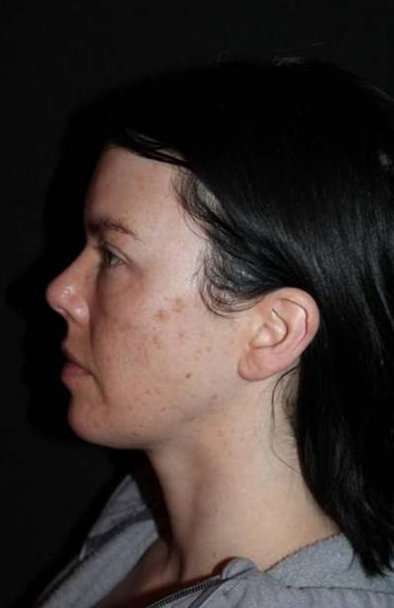 Browlift Before & After Gallery - Patient 396351 - Image 6