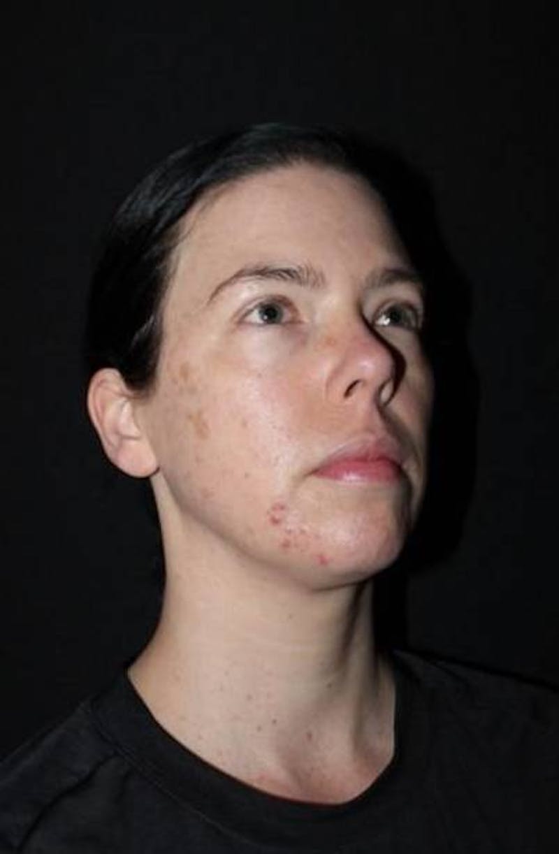 Browlift Before & After Gallery - Patient 396351 - Image 7
