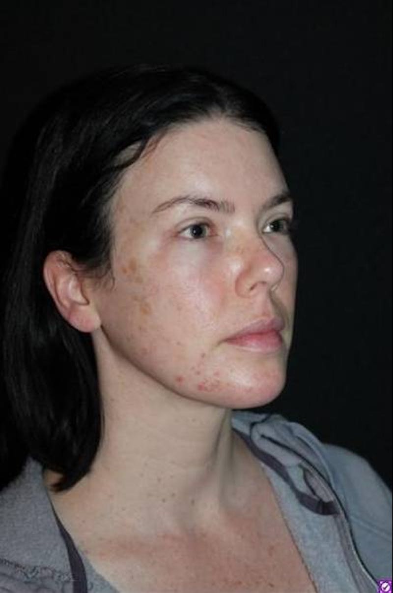 Browlift Before & After Gallery - Patient 396351 - Image 8