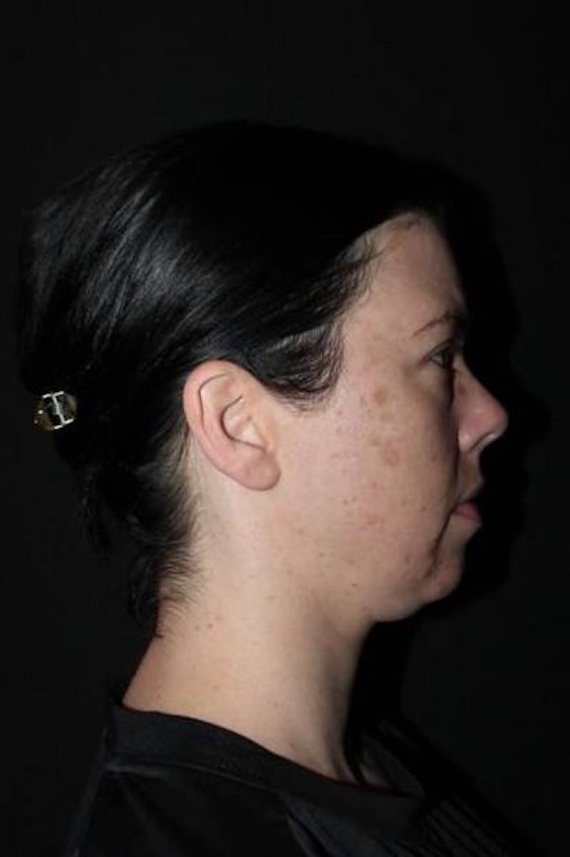 Browlift Before & After Gallery - Patient 396351 - Image 9