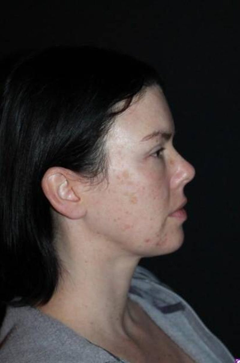 Browlift Before & After Gallery - Patient 396351 - Image 10