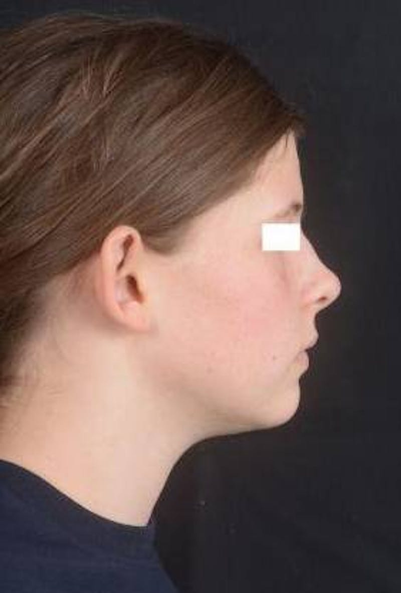 Otoplasty Before & After Gallery - Patient 179716 - Image 3