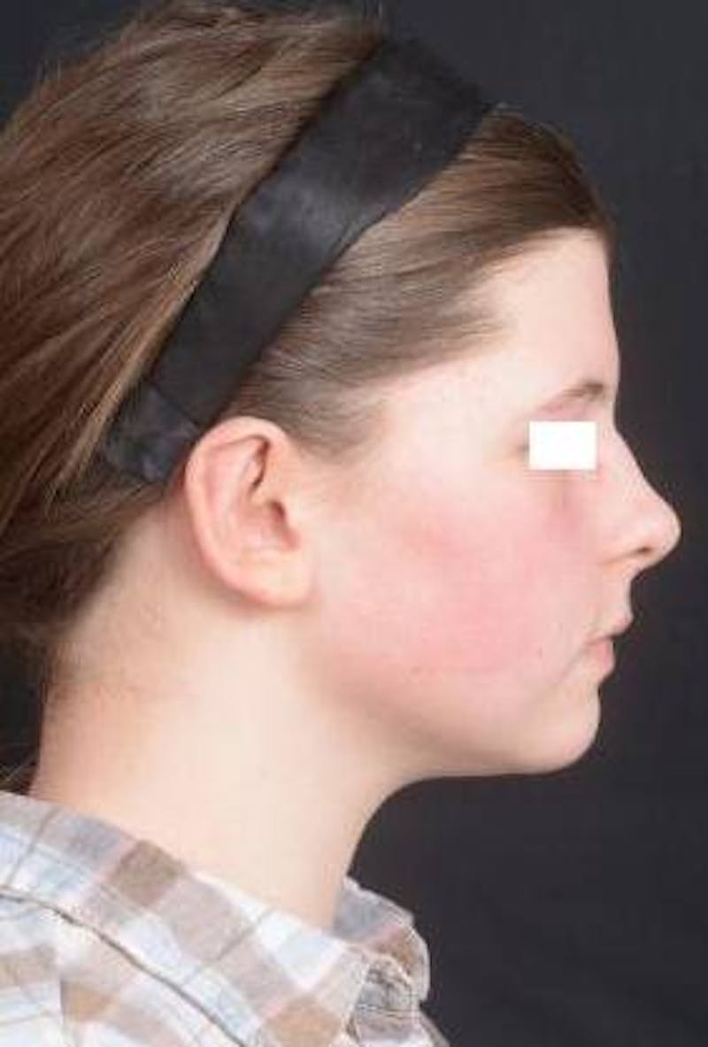 Otoplasty Before & After Gallery - Patient 179716 - Image 4