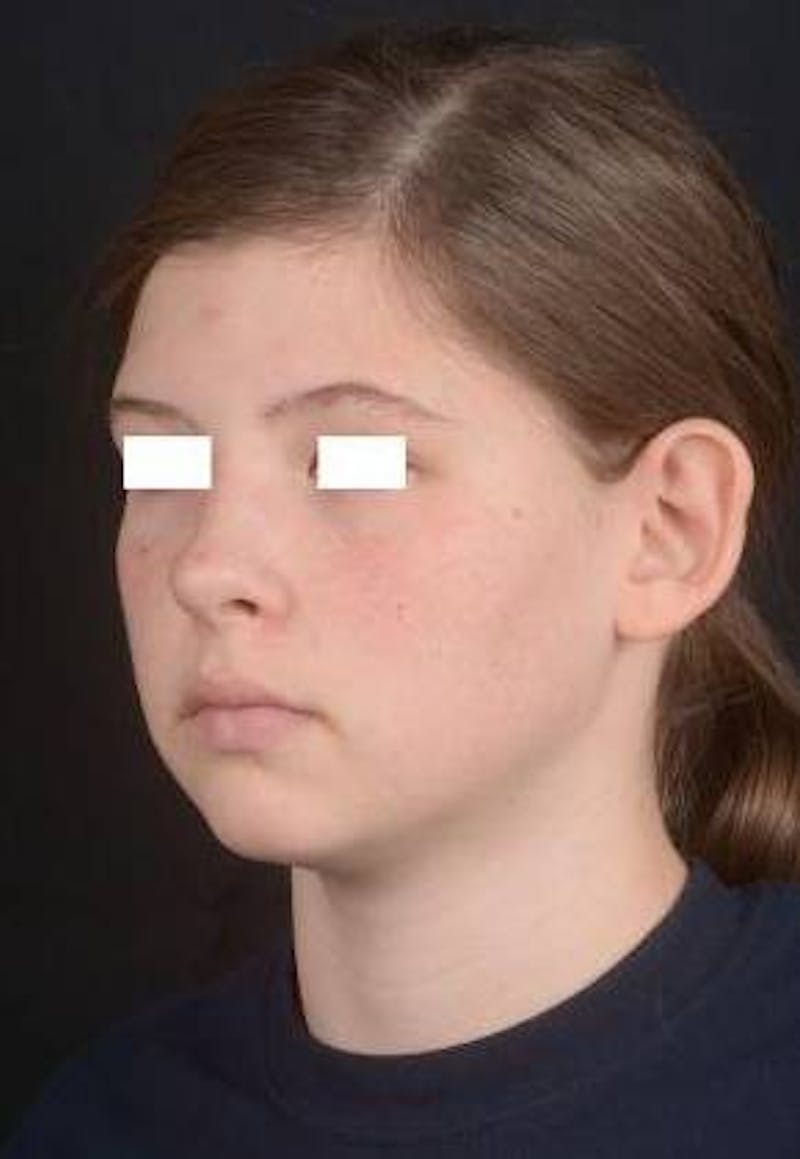 Otoplasty Before & After Gallery - Patient 179716 - Image 5
