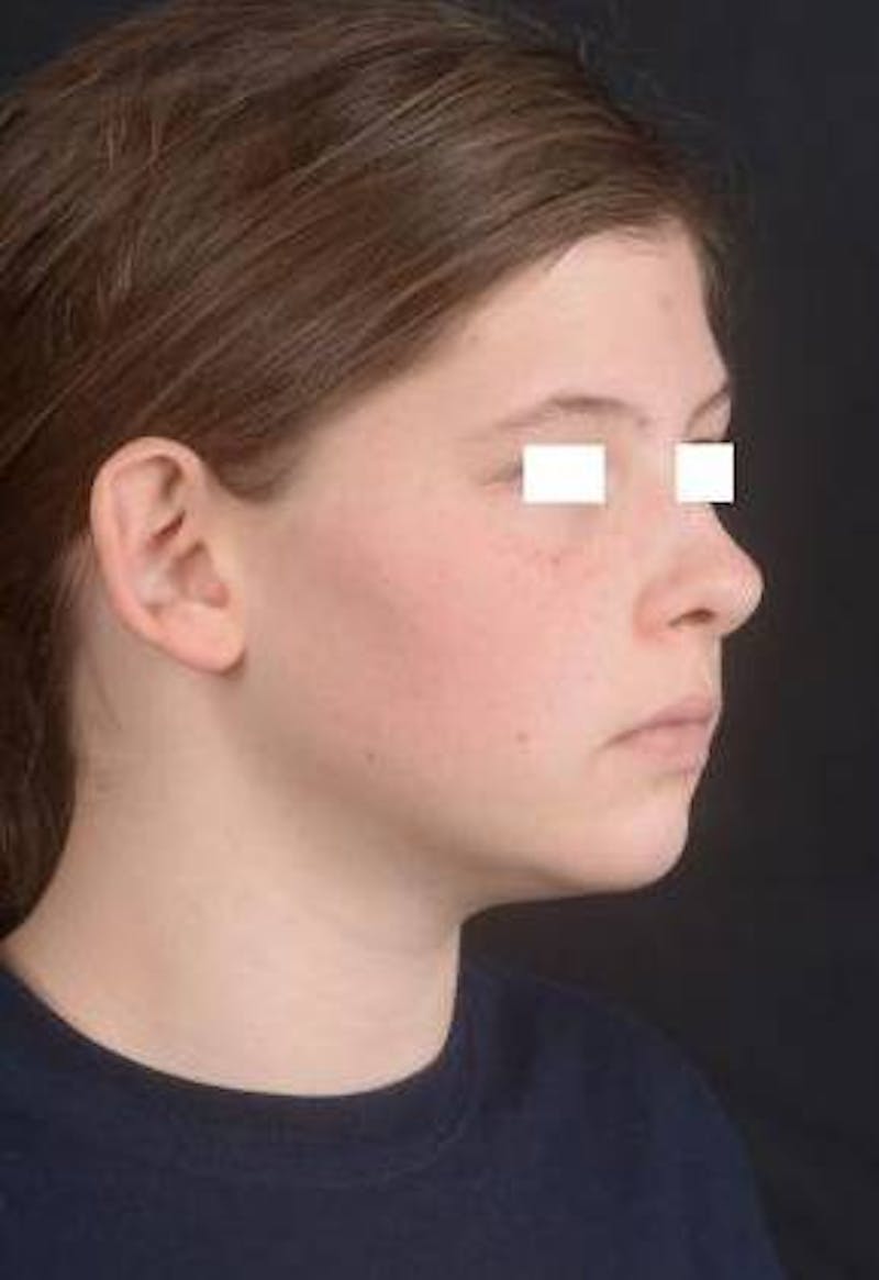 Otoplasty Before & After Gallery - Patient 179716 - Image 7